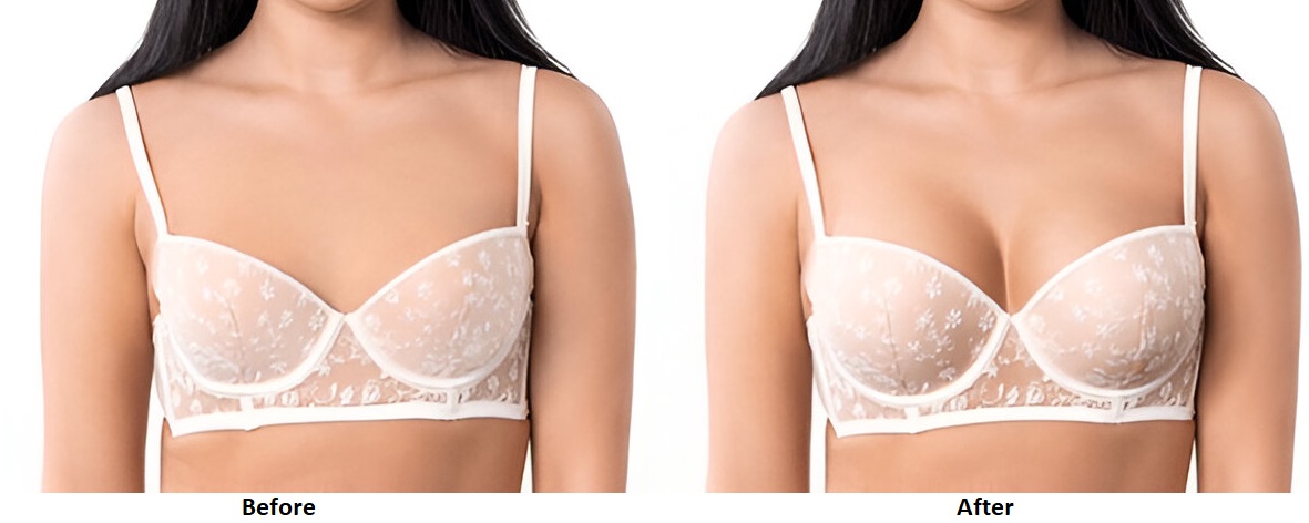 Before and After Breast Lift Surgery in Delhi